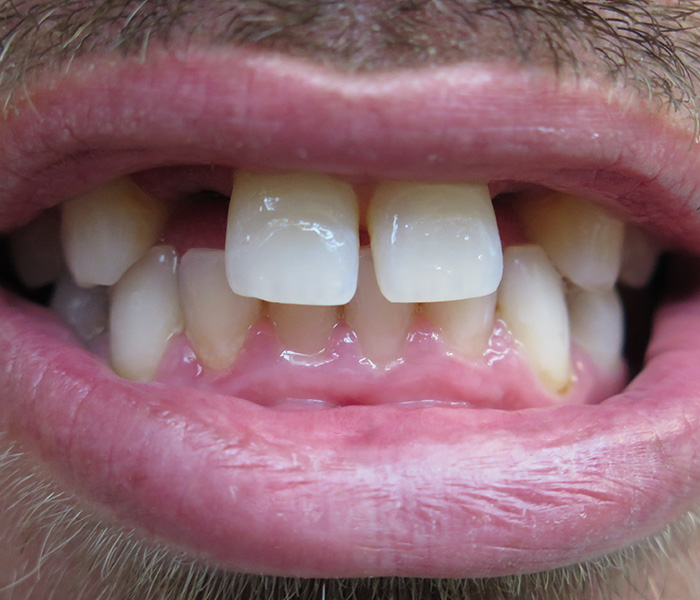 Dental implant before