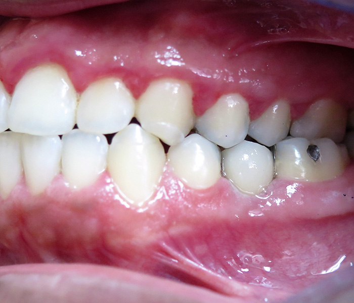 Dental implant after