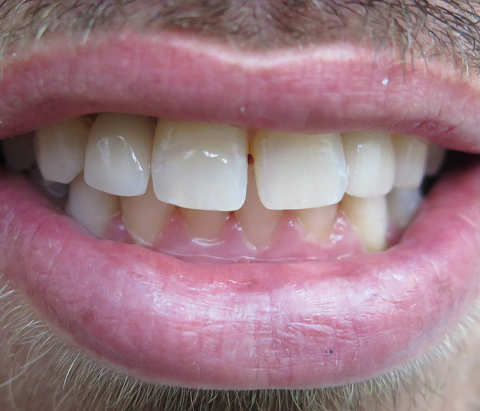Dental implant after