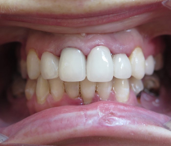 Dental implant after